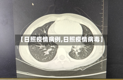 【日照疫情病例,日照疫情病毒】-第1张图片