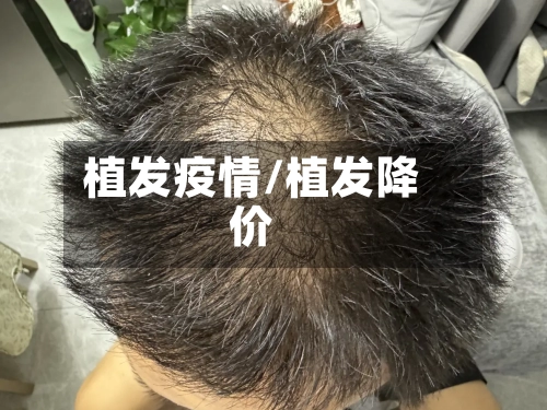 植发疫情/植发降价-第2张图片