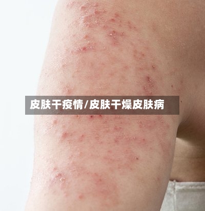 皮肤干疫情/皮肤干燥皮肤病-第1张图片