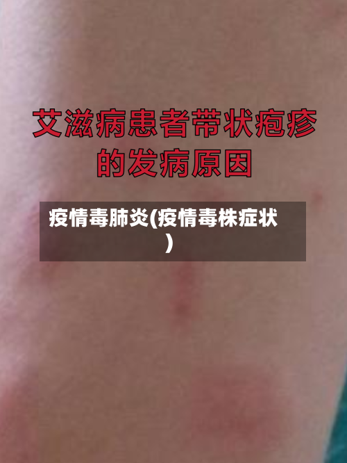 疫情毒肺炎(疫情毒株症状)-第1张图片